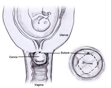 Cervical Cerclage: Technique, Pre-Procedure, Post-Procedure