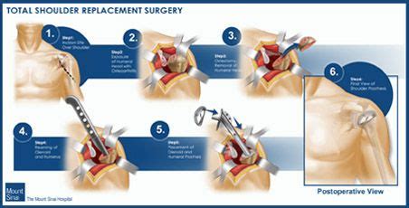 Orthopedic Surgery Gallery - The Mount Sinai Hospital | Orthopedic surgery, Orthopedics ...