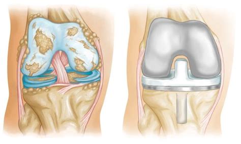 Knee Replacement Implants - OrthoInfo - AAOS