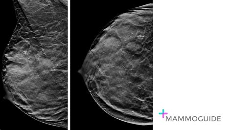 MAMMOGUIDE - Learn Breast Imaging - Breast Imaging Cases