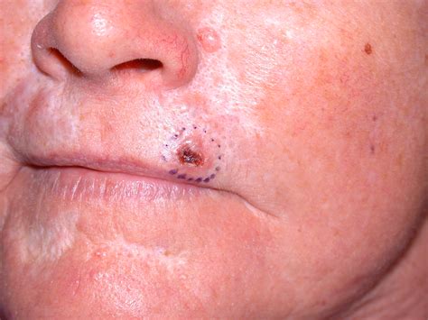 ACD A-Z of Skin - Basal cell carcinoma (BCC)