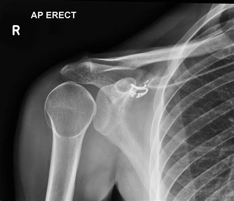 Posterior shoulder dislocation | Radiology Case | Radiopaedia.org Lght ...