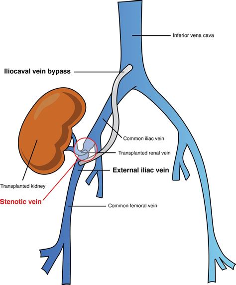 Common Iliac Vein