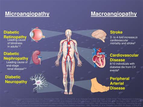 PPT - komplikasi deabetes mellitus PowerPoint Presentation, free download - ID:7164015