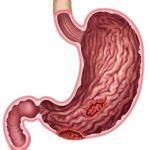 Top 8 stomach ulcer drugs: Treatment of stomach ulcer - Nigerian Health Blog
