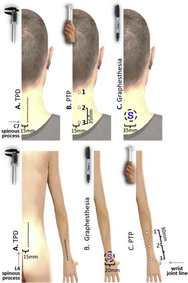 Tactile acuity is reduced in people with chronic neck pain - Musculoskeletal Science & Practice