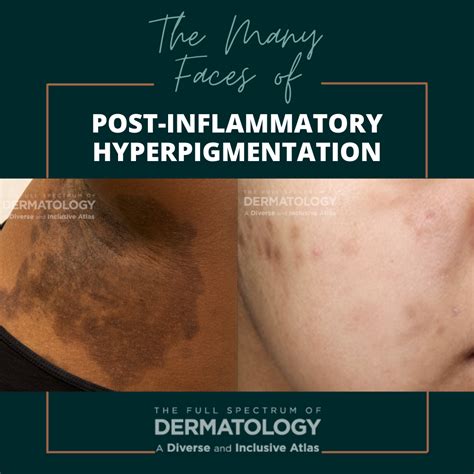 The Many Faces of Post-Inflammatory Hyperpigmentation (PIH) - Next ...