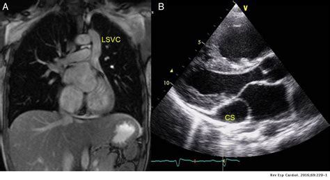 Persistent Left Superior Vena Cava With Absent Right Superior Vena Cava | Revista Española de ...