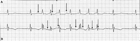 Atrial Ectopic Tachycardia in a Patient With Marfan Syndrome | Ochsner Journal