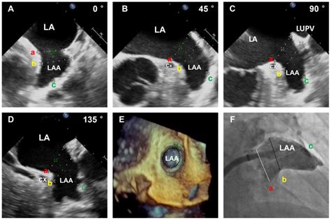 Role of real time‑three dimensional transesophageal echocardiography in ...