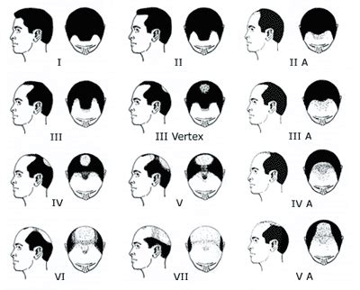 Male Pattern Baldness | MPB | Male Pattern Hair Loss | Alopecia | Baldness