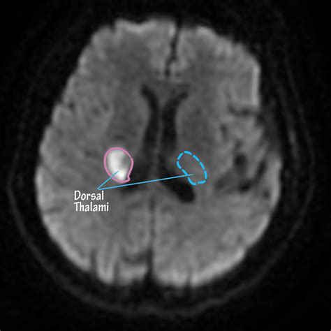 Neuroanatomy Glossary: Thalamic Stroke - Dorsal Thalamus | Draw It to ...