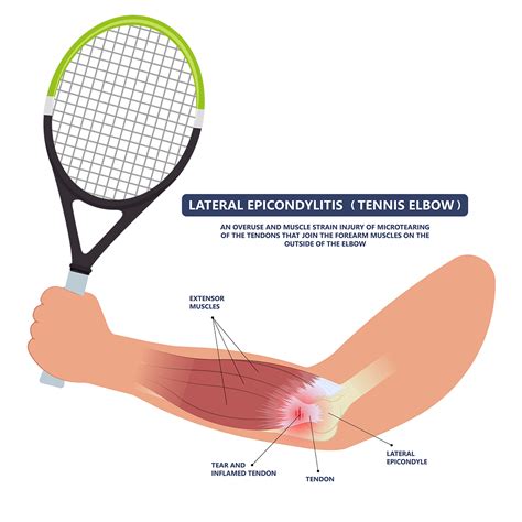 Lateral Epicondylitis