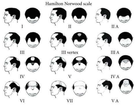 A Complete Guide To The Norwood Scale With 7 REAL Examples