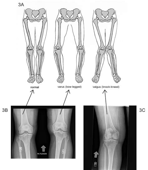 valgus knee - Google Search | Scoliosis exercises, Osteopathy, Pilates