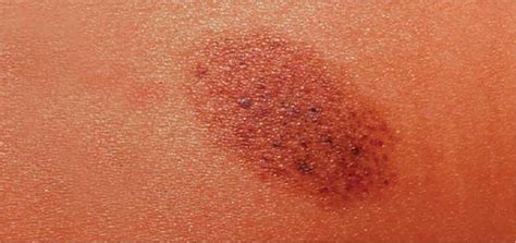 Of Macules and Melanocytes | Clinician Reviews