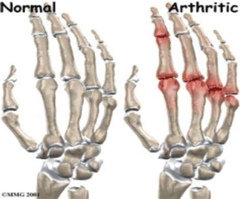 Metacarpophalangeal Joints