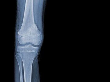 Premium Photo | Film xray of human knee showing closed fractureright ...