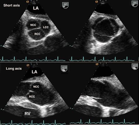 Figure 1 from Aortic stenosis: echocardiographic diagnosis. | Semantic Scholar