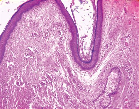 FULL TEXT - Recurrent postauricular dermoid cyst: A case report - International Journal of Case ...
