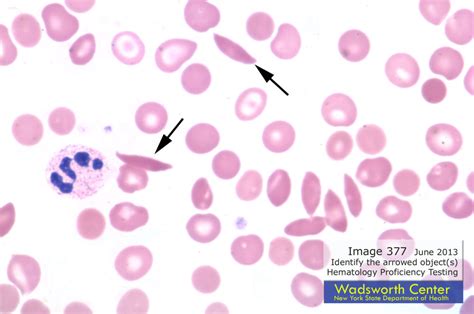 sickle cell anemia and drepanocytes on smear | Medical Laboratories