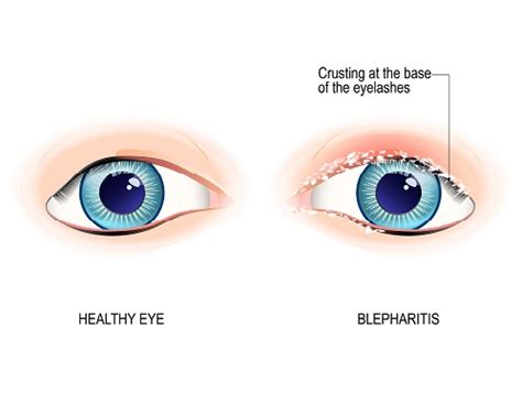 Blepharitis: Symptoms and Treatment | Fort Lauderdale Eye Institute