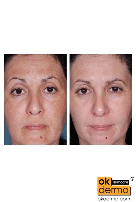 Melasma treatment retin a