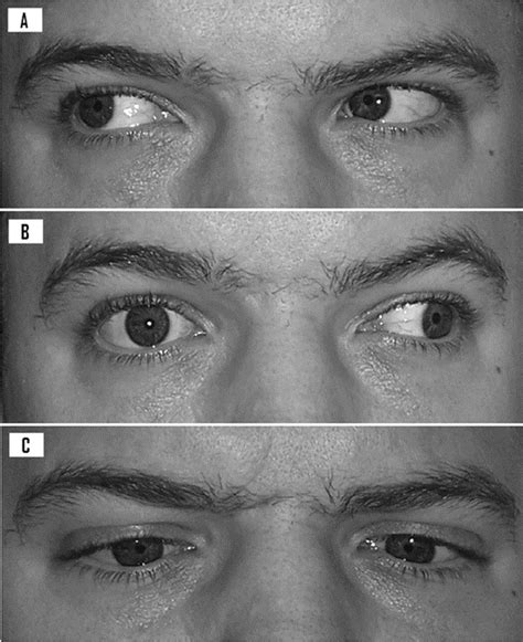 CluelessMedic — Internuclear Ophtalmoplegia (INO) caused by a...