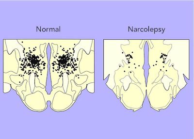 The Science of Narcolepsy | Sleep Medicine