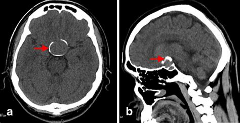 Craniopharyngioma And Pituitary Adenoma