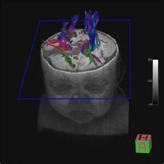 Preoperative MRI from patient 1, showing right hemimegalencephaly | Download Scientific Diagram