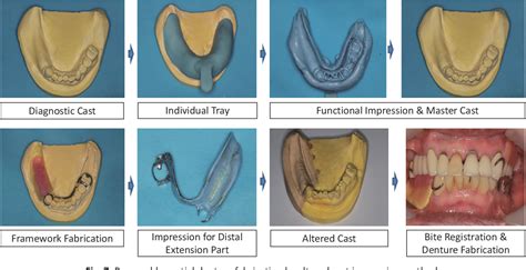 Figure 1 from Impression procedures for removable partial dentures | Semantic Scholar