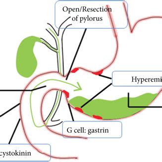 Pathogenesis of bile reflux gastritis. Reflux—gastroduodenal ...