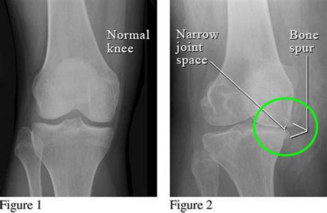 Bone Spur - Osteophytes, Causes, Signs, Symptoms & Treatment