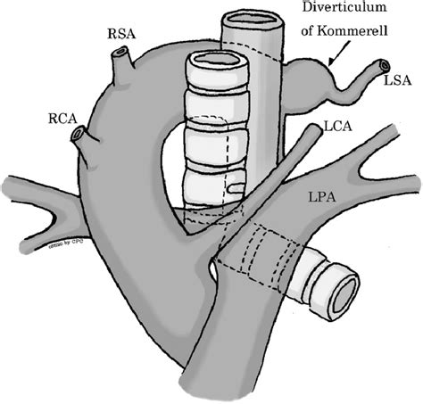 Right Aortic Arch With Aberrant Left Subclavian