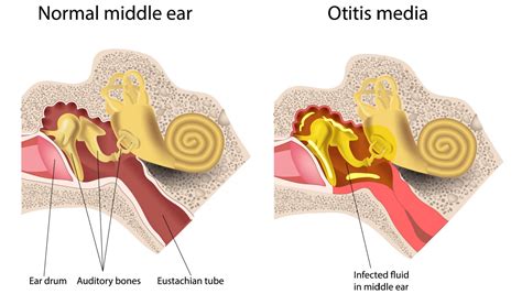 understanding otitis media | Happiest Health