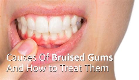 Causes Of Bruised Gums and How to Treat Them