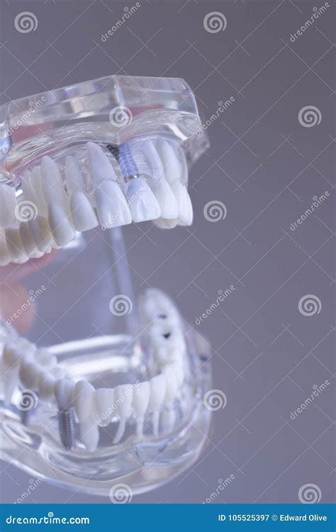 Dental teeth mouth model stock image. Image of implants - 105525397