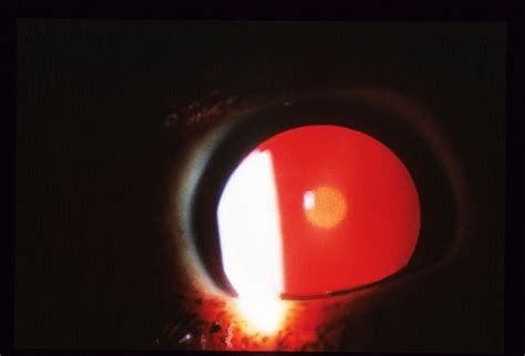 Congenital Cataracts - Retina Image Bank