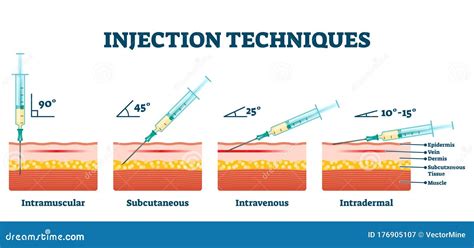 Injection Techniques Vector Illustration. Medical Procedure Examples Scheme Stock Vector ...