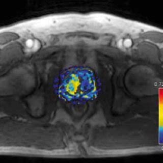 (PDF) Prostate imaging with 3T MRI in patiens with elevated PSA levels