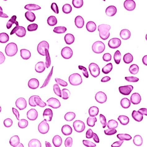 Sickle cell Anemia - Pathology Made Simple