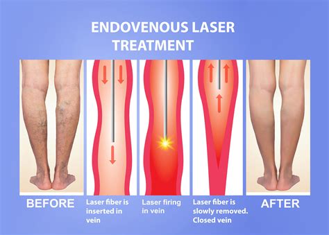 varicose vein surgery - DrBeckmann