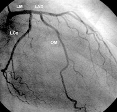 Om1 Coronary Artery Anatomy