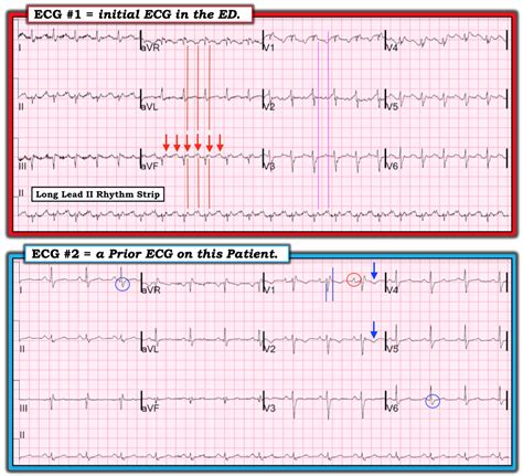 Dr. Smith's ECG Blog: Right sided heart failure and tachycardia.