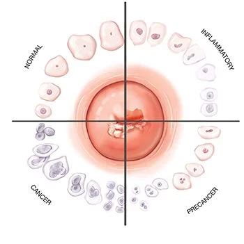 Abnormal Pap Smear Treatment | Best Gynecologists in NYC