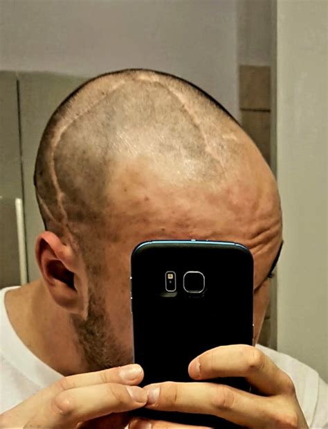 Brain surgery scars on the top of my head : r/mildlyinteresting