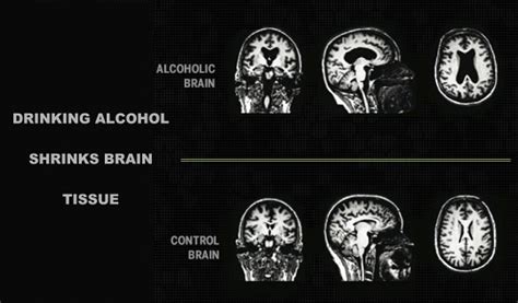 Alcohol Effects, Intoxication And Alcoholism - Health And Medical ...