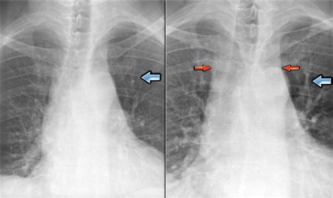 The Radiology Assistant : Chest X-Ray - Heart Failure