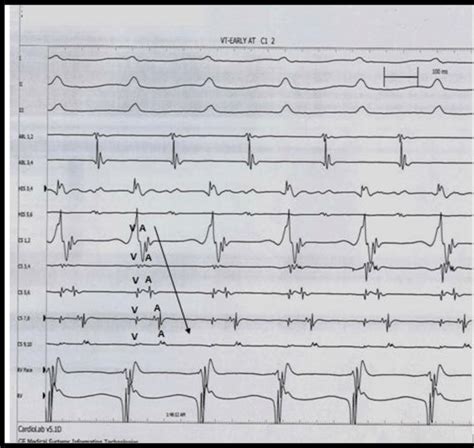 Intracardiac tracing during AVRT with three surface ECG leads and EGMs ...